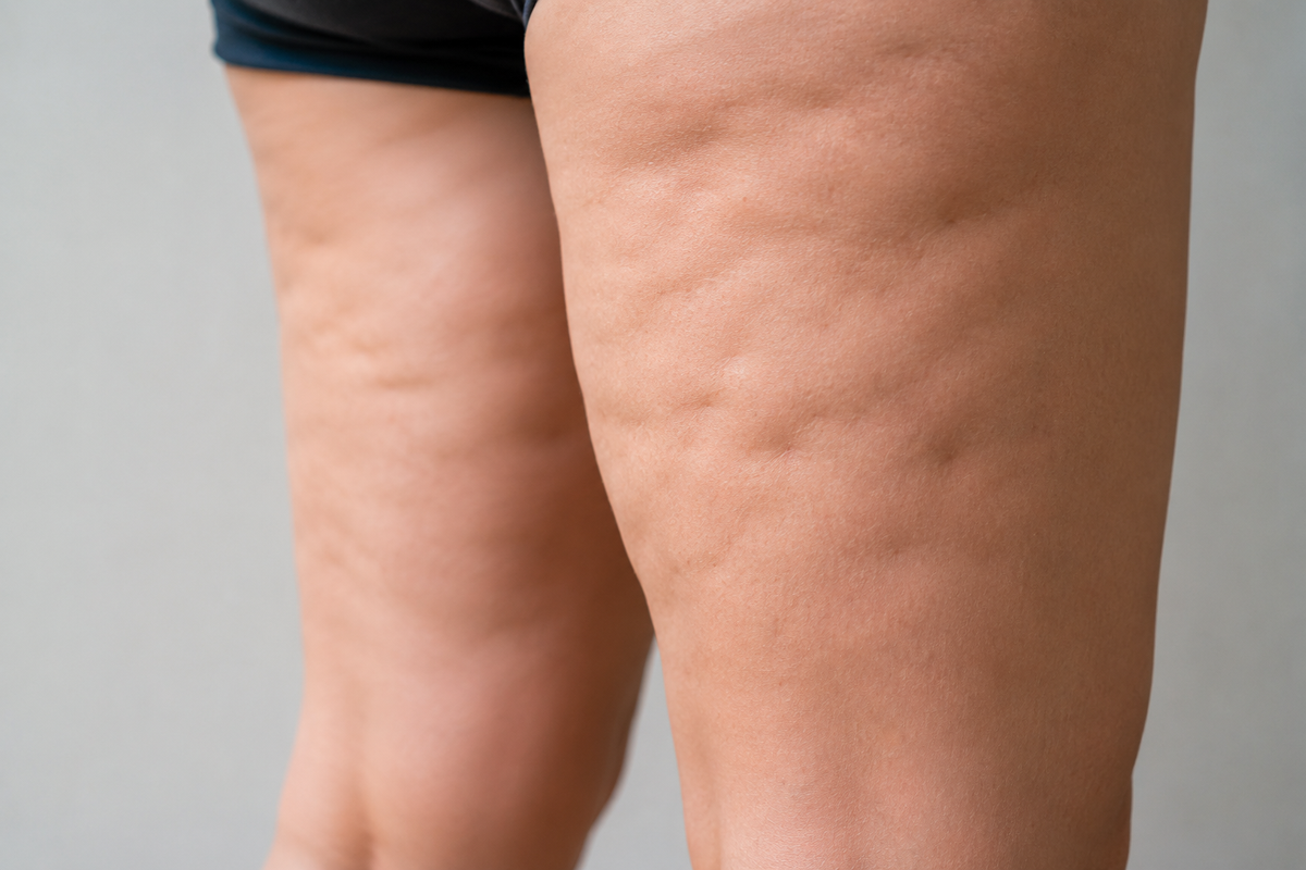 Le complexe anti-cellulite : la nouveauté qu’on attendait toutes !